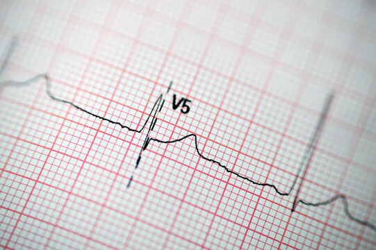 ECG ElectroCardioGraph Paper That Shows Sinus Rhythm Abnormality Of Right Ventricular Hypertrophy, Inferior T Wave Due To Hypertrophy And Ischemia, Abnormal ECG Study, Unconfirmed Diagnosis