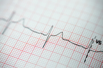 ECG ElectroCardioGraph paper that shows sinus rhythm abnormality of right ventricular hypertrophy,...