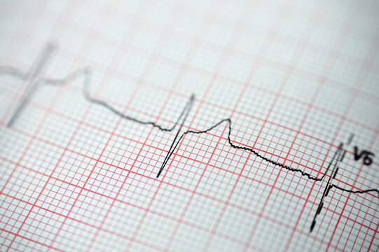 ECG ElectroCardioGraph Paper That Shows Sinus Rhythm Abnormality Of Right Ventricular Hypertrophy, Inferior T Wave Due To Hypertrophy And Ischemia, Abnormal ECG Study, Unconfirmed Diagnosis