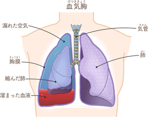 肺・気管・気胸・血胸・血気胸のイラスト