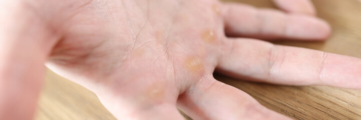 Calluses at distal palmar surface of hands.