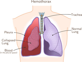 lungs,windpipe,hemothorax,pneumothorax,hemopneumothorax,illustration