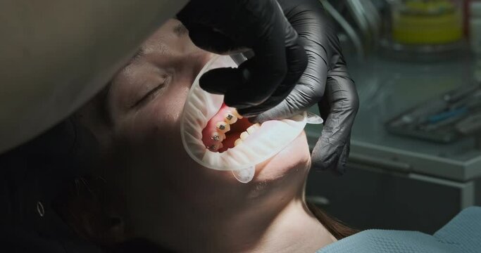 Orthodontist removes braces from teeth. Nippers bite off the glued iron braces.