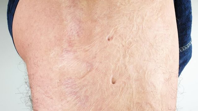 Burn scars, burn scars on the body. Consequences of burns.Burn marks on the man's body.