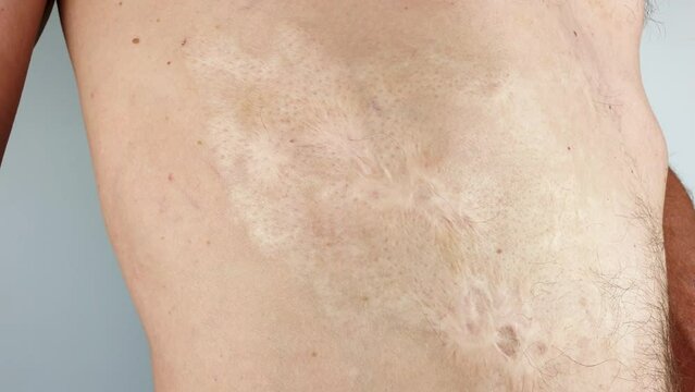 Burn scars, burn scars on the body. Consequences of burns.Burn marks on the man's body.