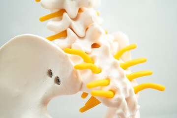 Lumbar spine displaced herniated disc fragment, spinal nerve and bone. Model for treatment medical...