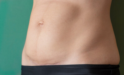 Fototapeta na wymiar Photo of a woman's abdomen after a caesarean section