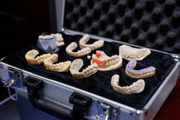 Plaster impressions - jaws model with support pins for bite registration.