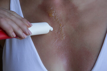 Woman applaying ointment on second-degree burn with blister on her chest	
