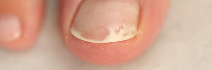 Close up view of damaged toenail, shallow depth of field.