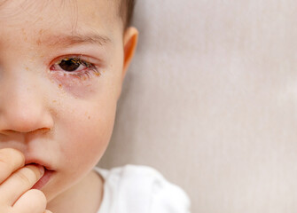 cute infant baby boy with purulent acute bacterial conjunctivitis lying on bed. puffy red eye, virus infection.mother giving eye drops to kid child - obrazy, fototapety, plakaty