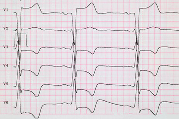 ECG. Myocardial infarction on ECG, subendocardial ischemia in chest leads. Angina. Chest pain....