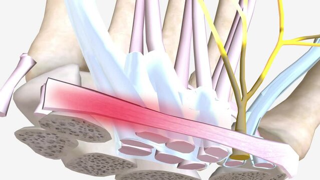Carpal tunnel syndrome (CTS) is a common neurological disorder that occurs