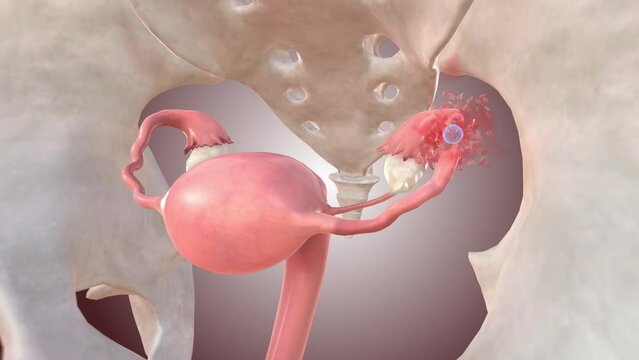 Ectopic pregnancy embryo causes tube rupture