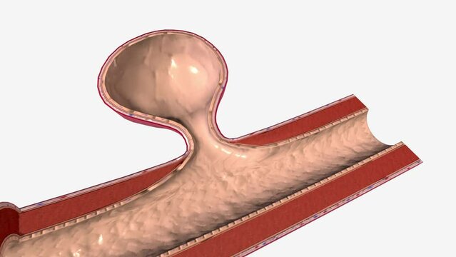 Berry (saccular) aneurysms are the most common type of intracranial aneurysm