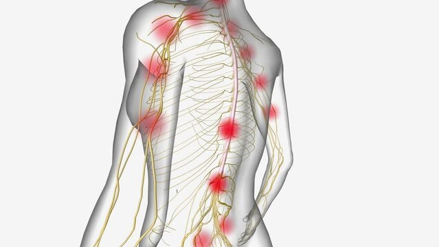 Central Sensitization Heightened sensitivity along spinal cord