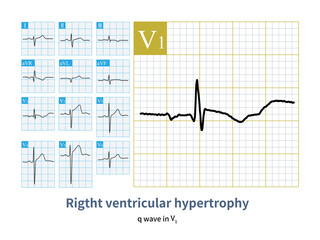 Male, 40 years old, clinically diagnosed with atrial septal defect. QRS waves showed qRs morphology in lead V1, and the appearance of q wave indicated right ventricular hypertrophy.