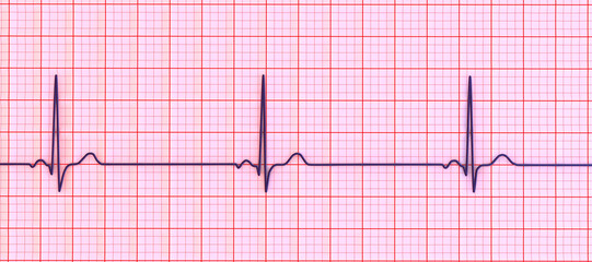 Electrocardiogram ECG displaying sinus bradycardia, 3D illustration