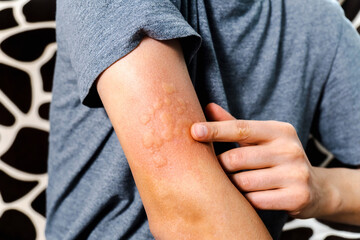 Red rash on skin from allergic reactions. Health care and medical concept, selective focus