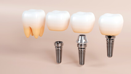 3d rendering of tooth and dental implant for stomatology set, Implants surgery concept