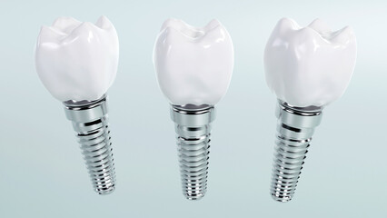 3d rendering of tooth implants with ceramic crowns on color background, Modern dental surgery concept