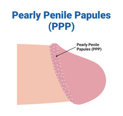Pearly Penile Papules (PPP) Medical Vector Illustration