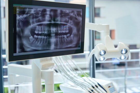 Monitor with the image of a dental x-ray