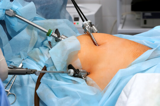 Operation on the stomach. Medical procedure for treating a patient with a surgical intervention in the operating room