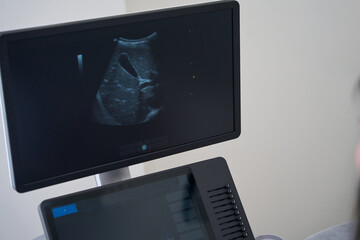 Monitor of ultrasound machine with the image of internal organs
