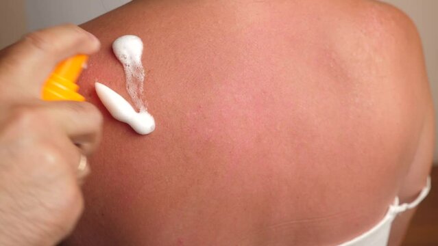 The foam is applied to sun-damaged areas of the skin. Sunburns on the skin. Body skin care. Protection against excessive sunburn and skin irritation.