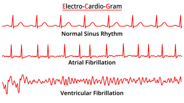 Set of ECG Common Abnormalities - Atrial Fibrillation - Ventricular Fibrillation - Normal Sinus Rhythm - Electrocardiography Vector Medical Illustration