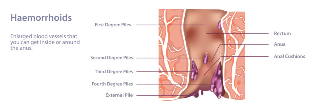 Hemorrhoids, or piles, are a common issue. These swollen veins inside of your rectum or outside of your anus can cause pain, anal itching and rectal bleeding. vector. Eating more fiber can help.