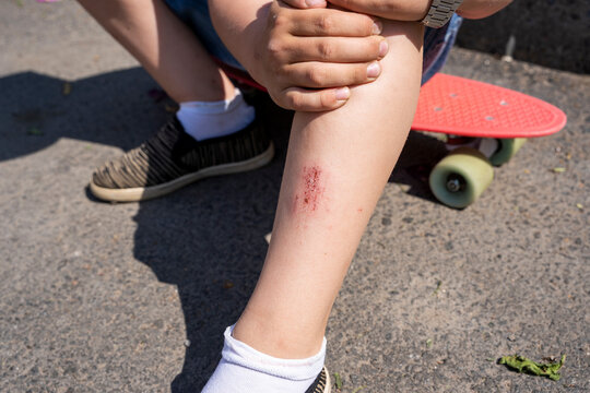 an abrasion on a child's leg from falling on an asphalt path 