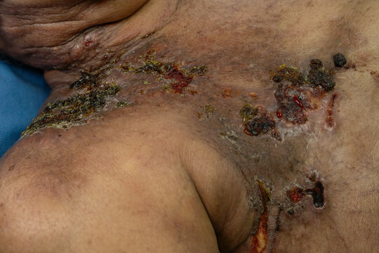 Medical themes: Radiotherapy breast cancer dermatitis. Right mastectomy and right arm lymphangitis