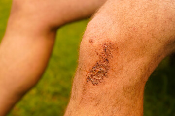 Abrasion on the knee from falling on the ground. People, healthcare and medicine concept