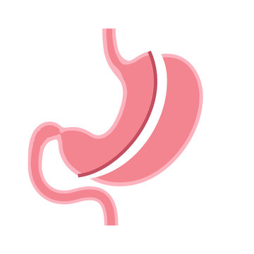 Surgical sleeve gastrectomy