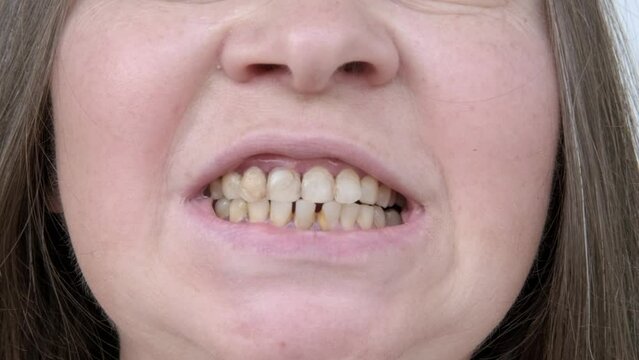 close-up of Curved teeth with yellow tooth stain, tartar teeth on enamel, woman with open mouth, conceptdental hygiene practices, dental prosthetics, oral care, Choose tartar-control