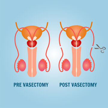 Male  vasectomy infographic in vector illustration 