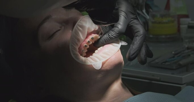 Patient squints in pain. Orthodontist removes braces with dental nippers. Open mouth with retractor, close-up.