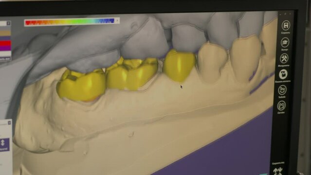 User interface of the modern 3D dentistry software. Examining the jaw model in the dentistry software interface. Analysing the replacement teeth prototypes in the dentistry software interface.
