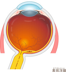 眼球・黄斑浮腫・macular edema・イラスト・eye・illustration