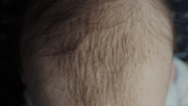 Seborrheic dermatitis on the skin on the head of a 6 month old baby. Yellow scales on the head, close-up