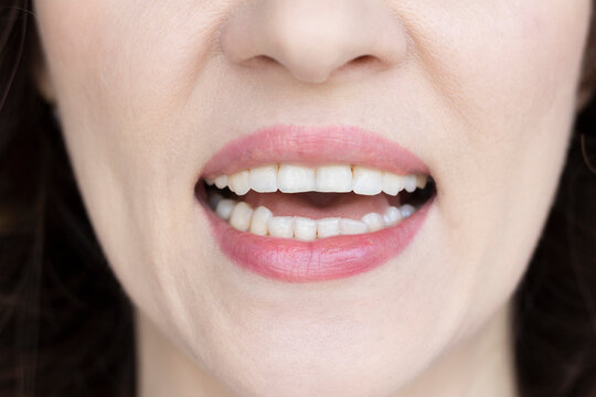 Woman shows off her chipped teeth. Bruxism, stress, malocclusion.