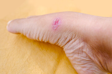 closeup of weeping wound, trophic ulcer on female leg, wound exudate prevents healing ulcers by destroying growth factors, concept of self-treatment at home, sanitation pathogenic microflora