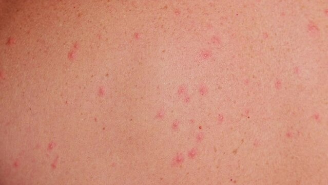 Man's back with acne, red spots, skin disease. Varicella or Herpes Zoster concept