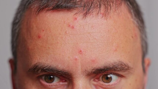 Man's forehead with acne, red spots, skin disease. Varicella or Herpes Zoster concept