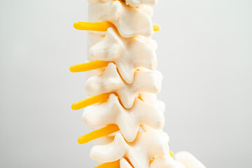 Lumbar spine displaced herniated disc fragment, spinal nerve and bone. Model for treatment medical in the orthopedic department. - obrazy, fototapety, plakaty
