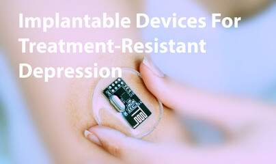 Implantable Devices For Treatment-Resistant Depression Implantable Electronic Medical Devices...