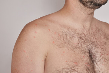 Shoulder and chest of a man with acne, red spots, skin disease