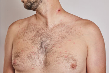 Naklejka premium Man with acne, red spots, skin disease